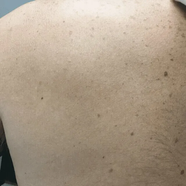 Photo 3 of Removery Tattoo Removal & Fading